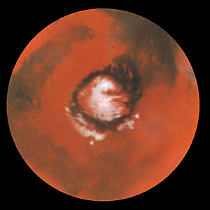 Seasonal Changes in Mars' North Polar Ice Cap
